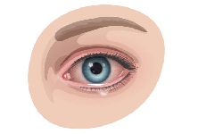 Eye infection
